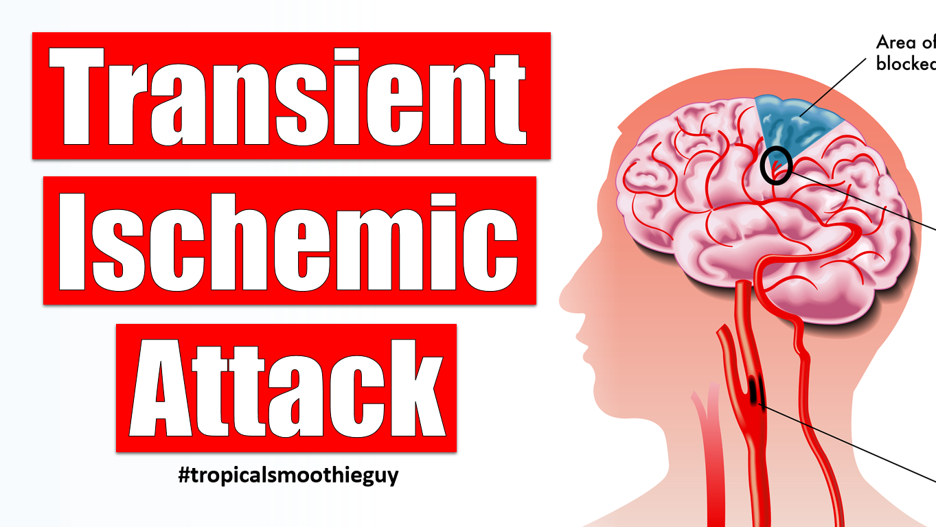 How A Transient Ischemic Attack Affects Your Brain