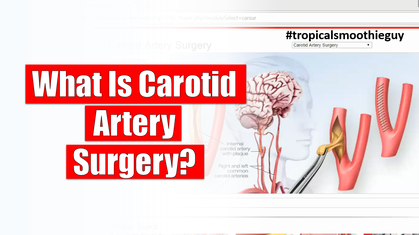 What Is Carotid Artery Surgery