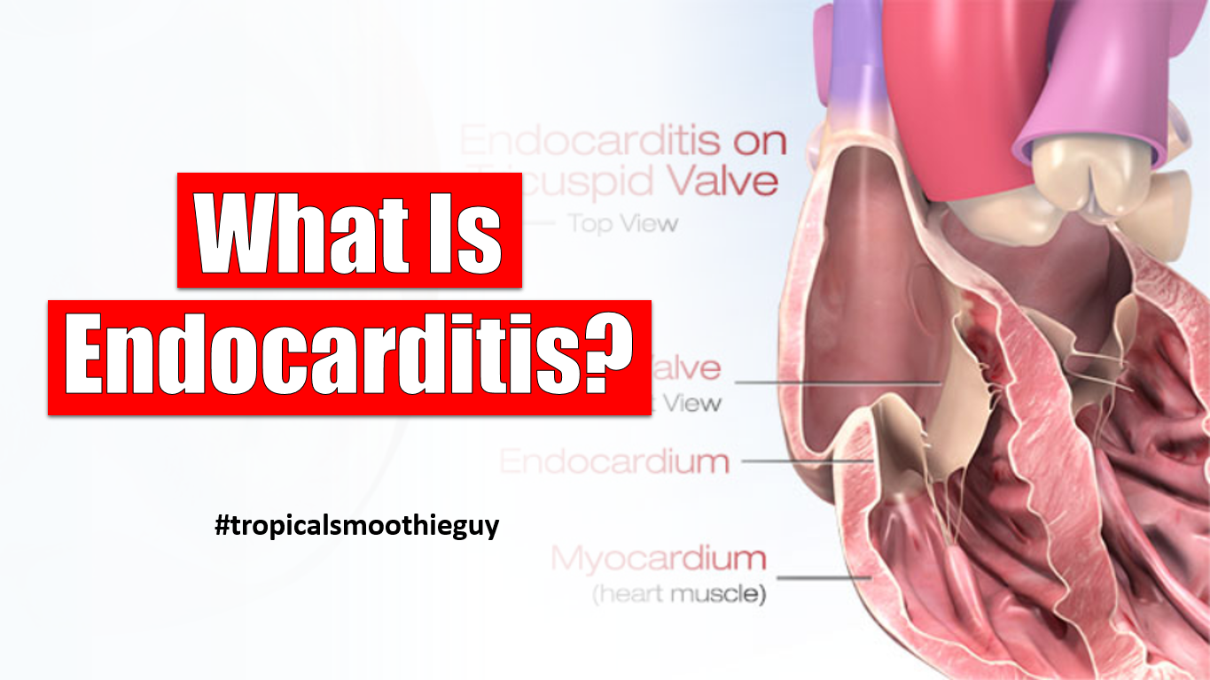 What Is Endocarditis?