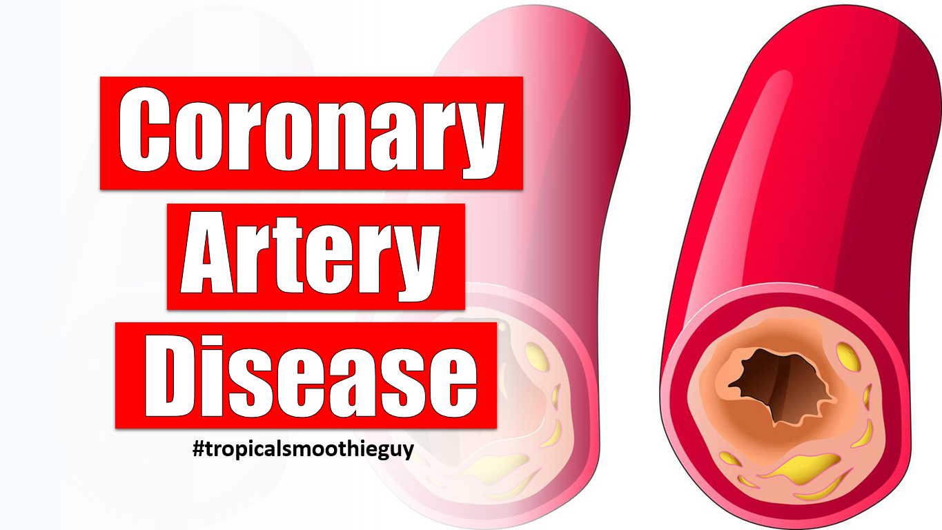 Coronary Artery Disease