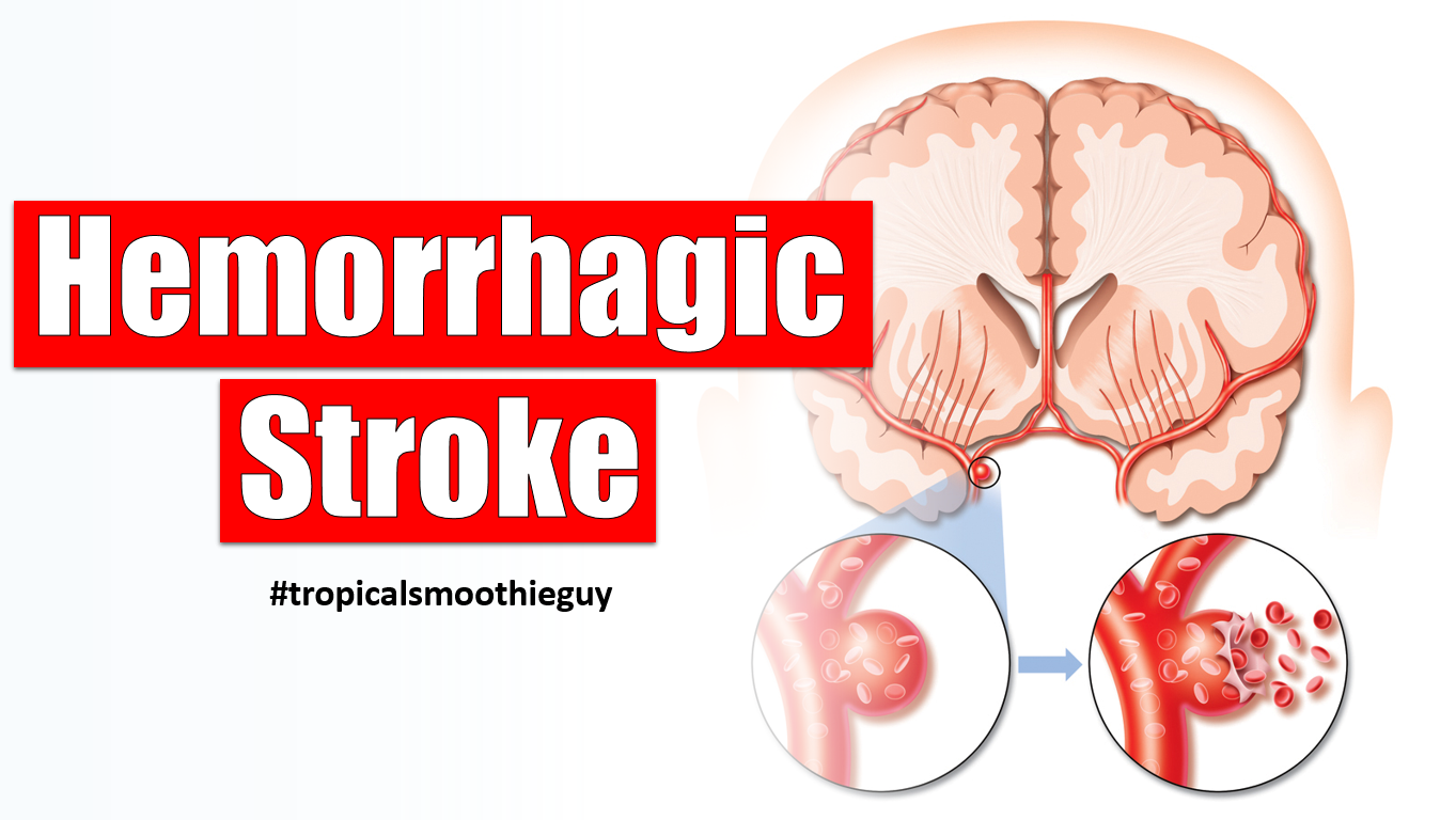 Hemorrhagic Stroke