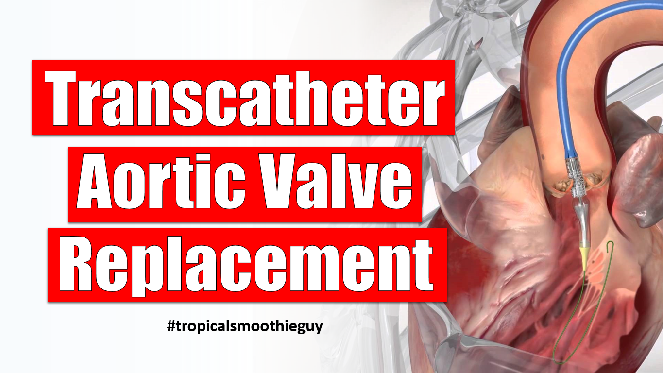 How The Transcatheter Aortic Valve Replacement Works