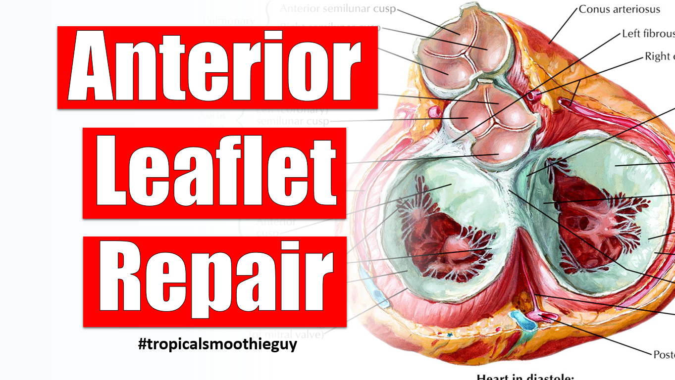 how-anterior-leaflet-repair-for-your-mitral-valve-works